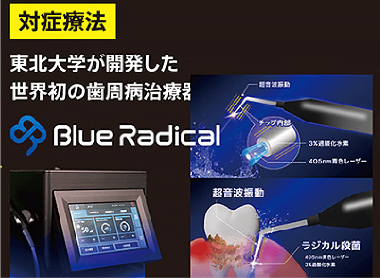 世界初、重度歯周病に光で治す
「ブルーラジカル」